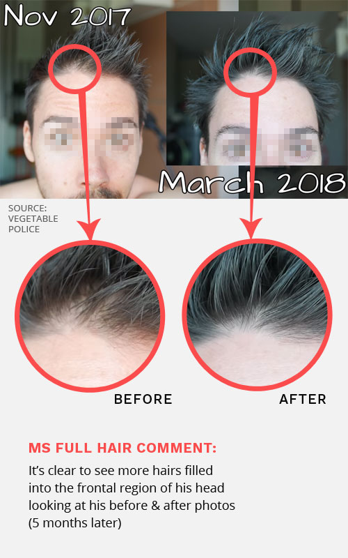 hair thinning treatment before after photos