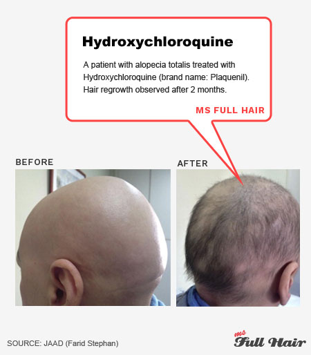 hydroxychloroquine plaquenil for alopecia areata alopecia totalis