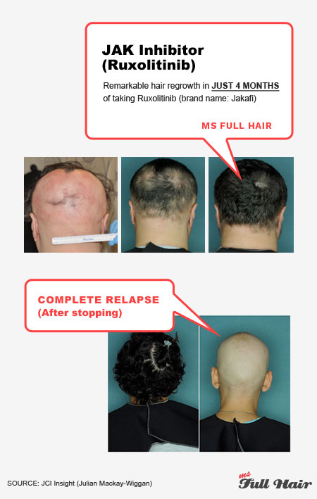 jak inhibitor ruxolitinib jakafi for alopecia areata treatment