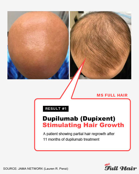 dupilumab dupixent for alopecia areata treatment