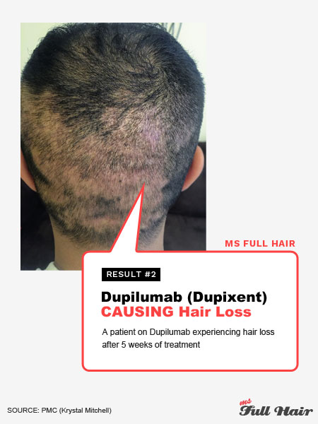 medication dupilumab dupixent induced hair loss alopecia areata symtpoms