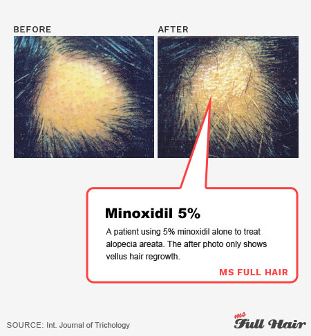 minoxidil dosage for alopecia areata