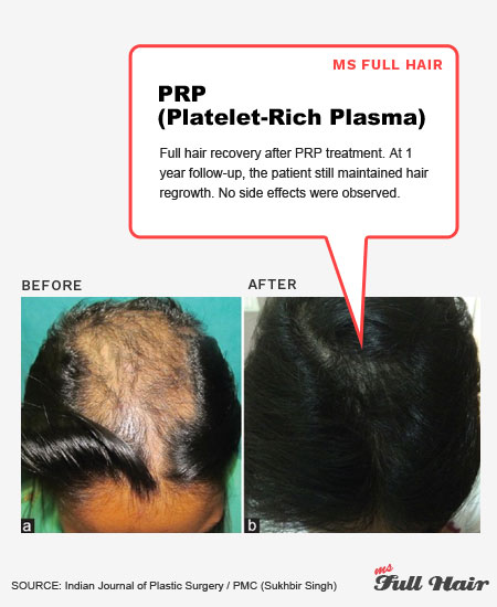 platelet rich plasma prp for hair loss alopecia areata