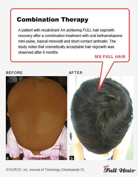 pulse corticosteroid minoxidil anthralin alopecia universalis treatment hair regrowth