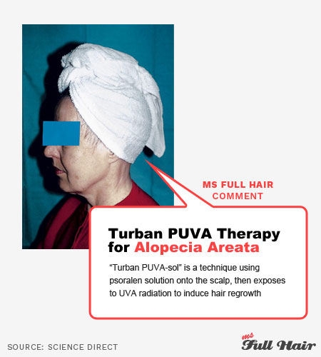 puva turbansol topical psoralen therapy for alopecia areata treatment