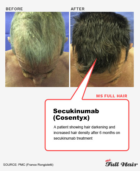 secukinumab cosentyx for alopecia areata