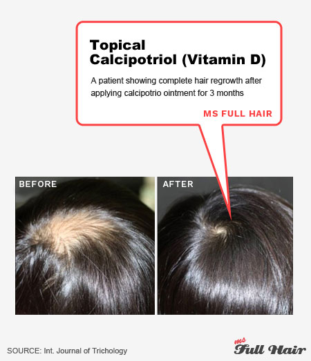vitamin d topical calcipotriol for alopecia areata treatment