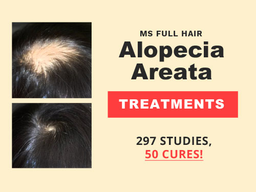 whats the best alopecia areata treatment 297 aa studies 50 baldness cure solutions