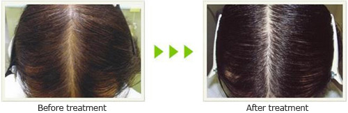 cayenne pepper soy for hair loss before after pictures