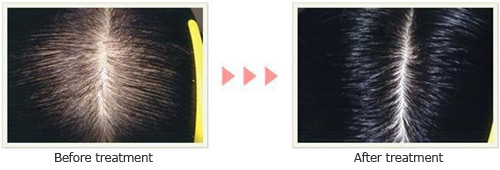 igf 1 soy and capsaicin for hair growth