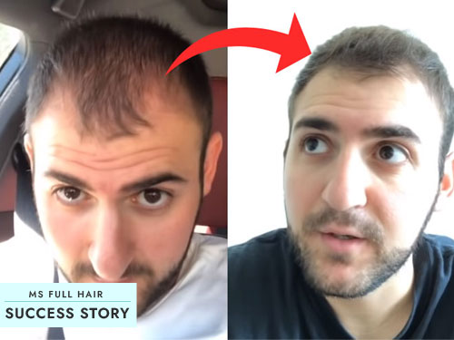 hair loss success story reverse male pattern hair loss