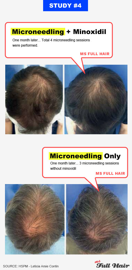 minoxidil derma roller hair growth results