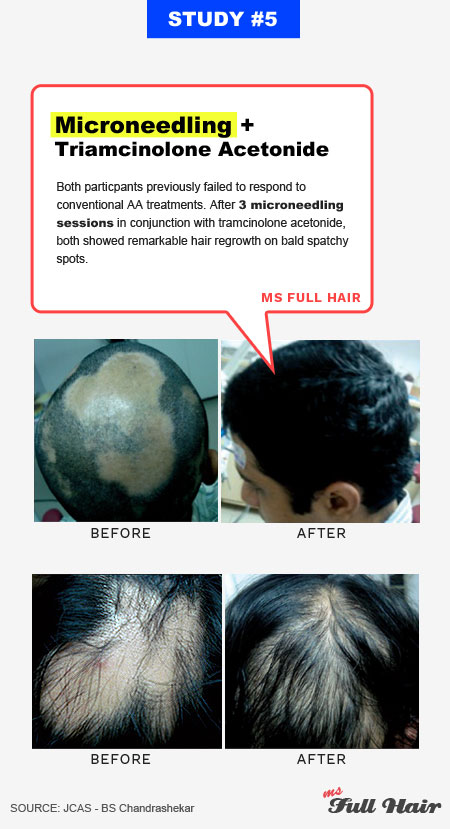 microneedling derma roller for alopecia areata hair loss
