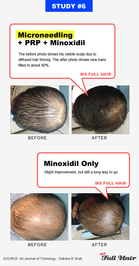 microneedling with prp for hair loss