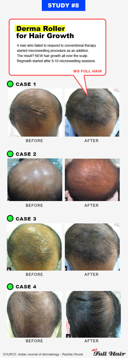 dermaroller for hair loss androgenic alopecia pattern baldness