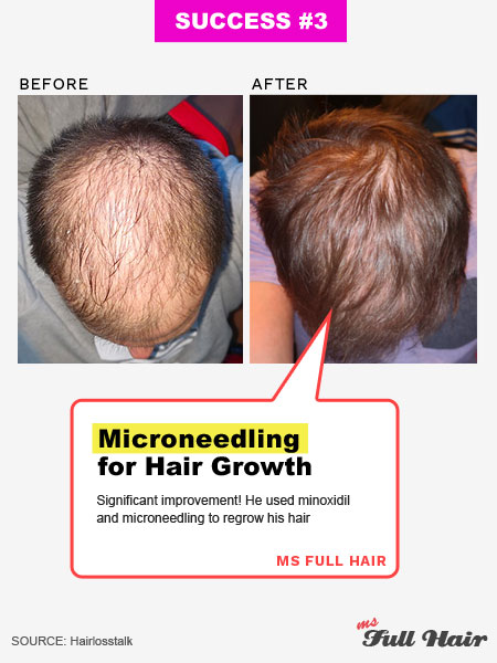 microneedling for hair loss at home review