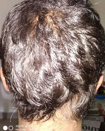 alopecia areata hair regrowth naturally before and after photos