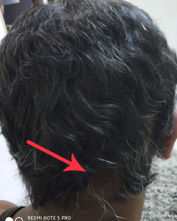 alopecia areata hair regrowth before and after photos