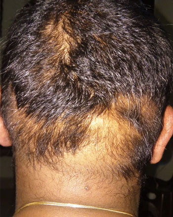alopecia areata hair regrowth before and after transformation