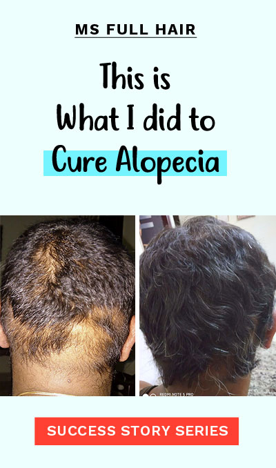 Alopecia Areata Hair Regrowth Success Story 