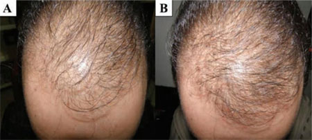 minoxidil vs rosemary oil for regrowth before and after results