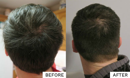 rosemary oil for hair growth before and after results