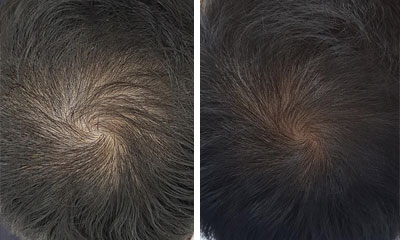 asian herbs for hair loss before and after photos