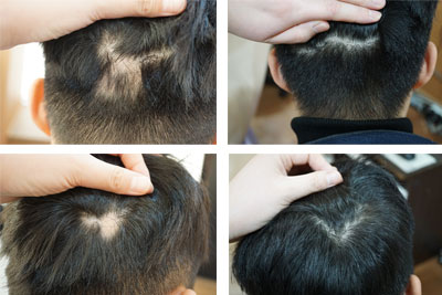 pharmacopuncture for hair loss before and after