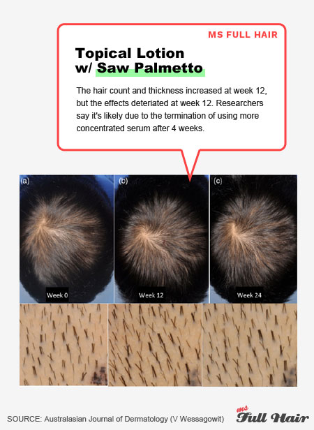 saw palmetto hair loss study before and after photos